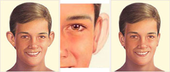 outcome -otoplasty-Tunisia